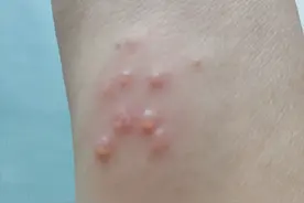 胳膊上一片红疹，以为是蚊子咬的，后来鼓出泡泡，原来是带状疱疹图片