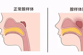 女演员霍思燕为儿子辟谣的“腺样体面容”，长啥样？图片