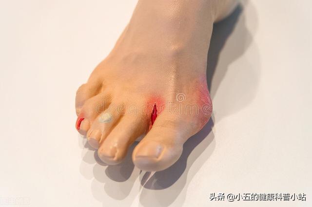 糖尿病人脚麻如何缓解（糖尿病患者感觉脚冷脚麻千万别随意泡脚）
