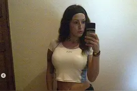 加拿大女网红沉迷整形，结果胸给隆“炸”了，剩单侧巨乳图片