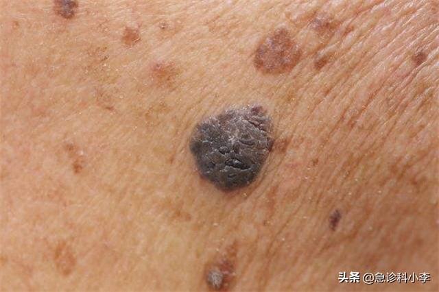 手上长了很多小红点