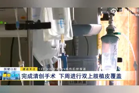 13岁女孩全身85%烧伤后续报道：完成清创手术 下周进行双上肢植皮覆盖图片
