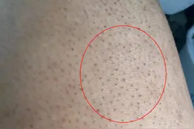 擦掉“鸡皮肤”，原来这么简单，皮肤科医生教你图片