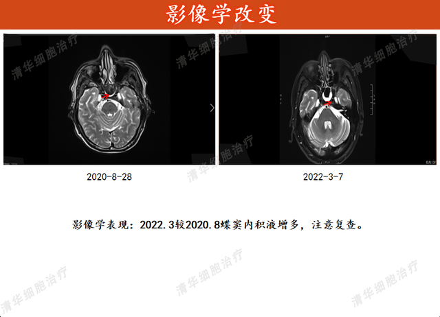 非角化型鳞状细胞癌的药物治疗