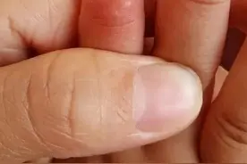 痒死了！天气一热孩子就长疱疹，到底该怎样预防？图片
