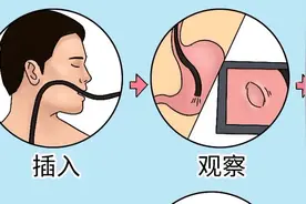 协和科普：胃肠镜检查详细攻略，9类高危人群建议必查图片