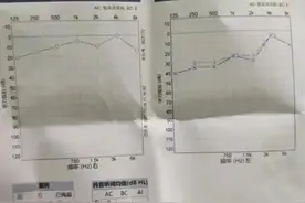 突发性耳聋就这样治愈了图片