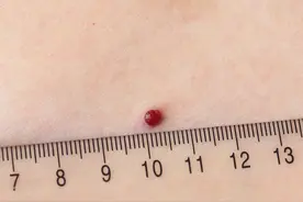 身上不疼不痒的小红点到底是什么？图片