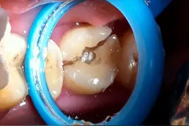 安装假牙后，牙齿却突然疼痛不已，小心里面已经烂光图片