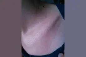 别忽视脖子上的“小颗粒”，注意，这是丝状疣！一招教你变光滑图片