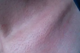 别忽视脖子上的“小颗粒”，注意，这是丝状疣！一招教你变光滑图片