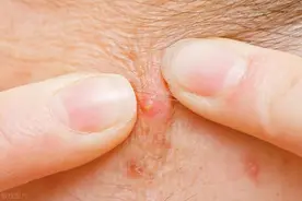 屁股长了个硬疙瘩一碰就疼，可能是这5个原因，医生：不懂别乱挤图片