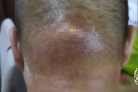 男子后脑勺小伤口变大脓包，医生：与他一个习惯有关图片