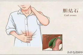 治疗胆结石的有效名方——四金化石汤图片