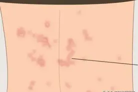 晚上瘙痒难忍，你可能得了这种病图片