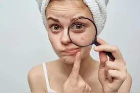 女性一来例假就长痘，难道是在“排毒”？告诉你姨妈痘的真相图片