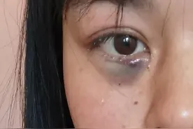 眼睑堵塞能有多严重，最后眼睛做了手术老公还被别人误会图片
