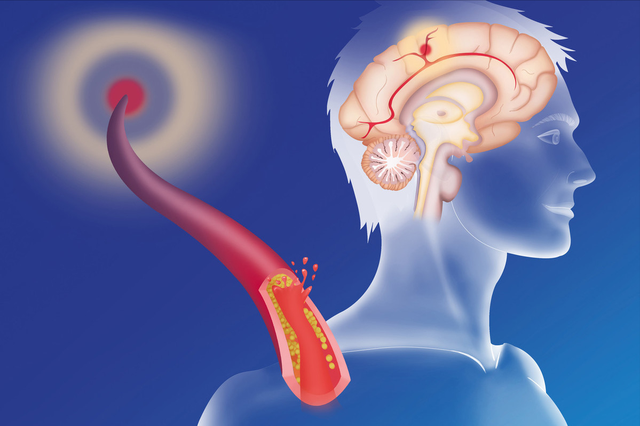 0.15元一片的甲钴胺是治疗腰椎间盘突出的神药吗？它有哪些作用？