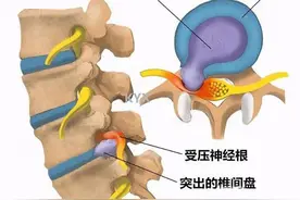 腰椎间盘脱出症及手术记录（九）图片