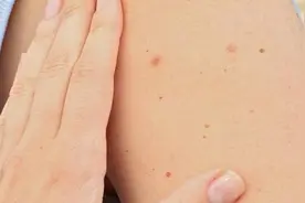 皮肤上莫名出现小红点，还不痛不痒，到底是什么？早知道早放心图片