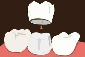 根管治疗后牙齿劈了，到底是谁的锅？专家：别把建议当回事儿图片