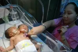 2011年，四川孕妇生下中国第一例“双头女婴”，最后怎样了？图片