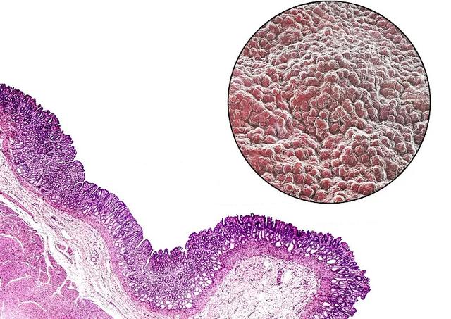 胃黏膜是胃部的护城河,这样做才能保护胃黏膜,学会可受益一生