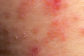 宝宝湿疹总是反复，和这几个因素有关图片