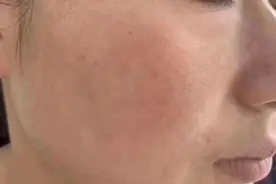 脸部长斑，变黄脸婆？别慌！这样做多年色斑也能改善图片