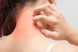 一到晚上就瘙痒难忍的荨麻疹，怎么回事？要怎么办才好？图片