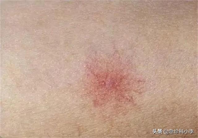 手上长了很多小红点