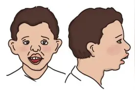 警惕！这种病影响孩子一生的颜值图片