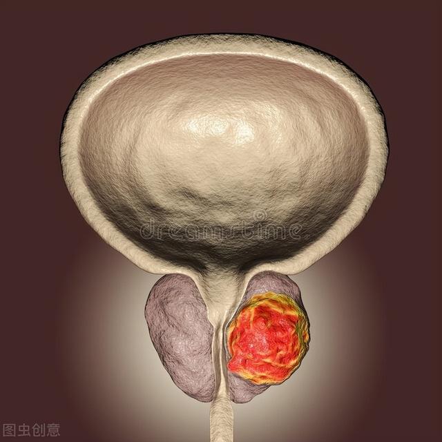 前列腺结石有什么危害（前列腺结石有多大的危害）