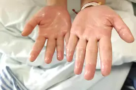 手汗症要去看胸外科图片