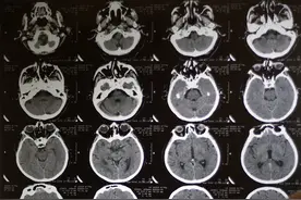 孩子突发脑梗，这些错家长们别再犯图片