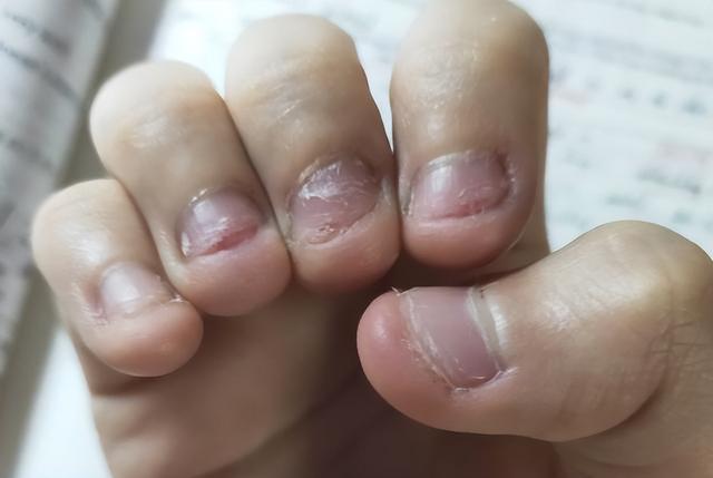孩子啃指甲发炎了怎么办 - 冷求网
