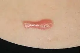 胸前疤痕疙瘩应该怎么治疗？胸前疤痕疙瘩最好的治疗方法图片