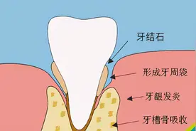 “牙结石”可以自己抠掉吗？教你几招，帮助牙缝脏东西轻松掉图片