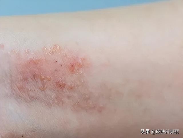 什么皮肤病和鸡皮肤很像