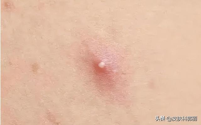 什么皮肤病和鸡皮肤很像