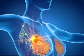 乳腺癌患者成功康复22年，她总结了4点成功抗癌经验与大家分享图片