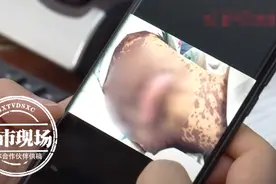 17岁少女皮肤痛如针扎，疑因吃了这种常见药图片