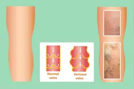 老年人腿肿、脚肿，千万别不当回事，谨防6个病因图片