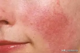 问题性敏感肌如何做好“精准护肤”图片