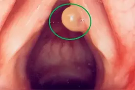 【一院·科普】声带小息肉，嗓音大文章图片