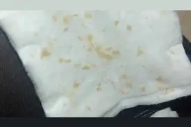 用手指刮过鼻子附近的皮肤，总能刮出一些泥状的脏东西，咋回事？图片