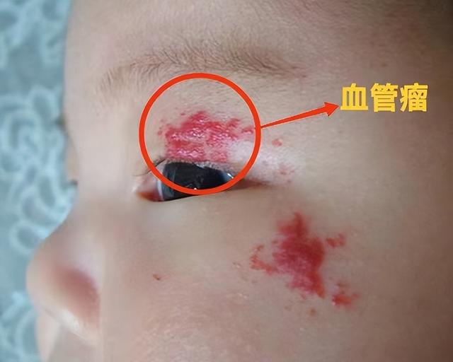 眼皮上长黄色的疙瘩是肿瘤吗？