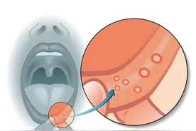 体内有癌，嘴巴先知？口腔若出现3种迹象，可能是癌症来临的警报图片