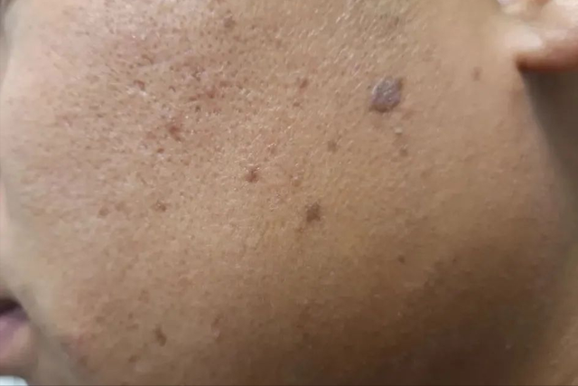 角化棘皮瘤的病理要点