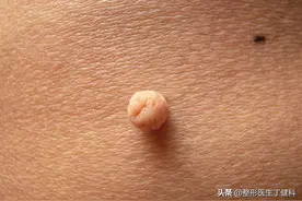 皮肤上长了个小肉球！不用慌，这篇文章告诉你该怎么办图片